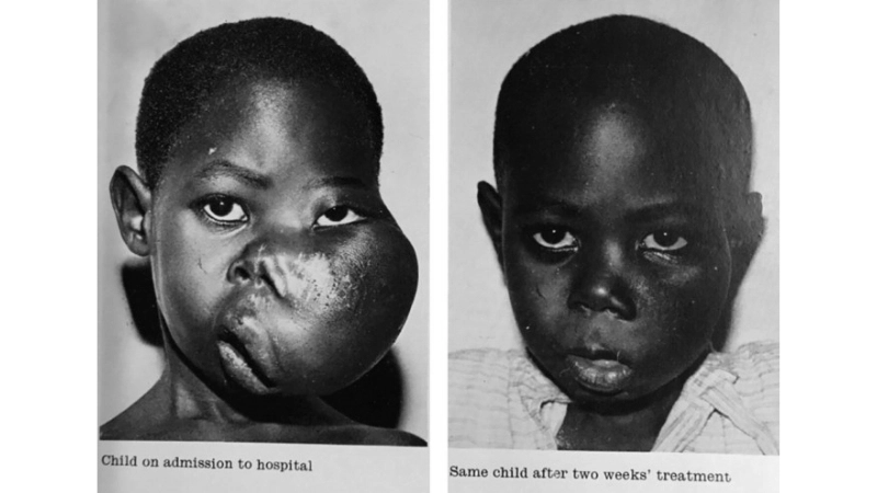 Burkitt's Lymphoma stages simplified