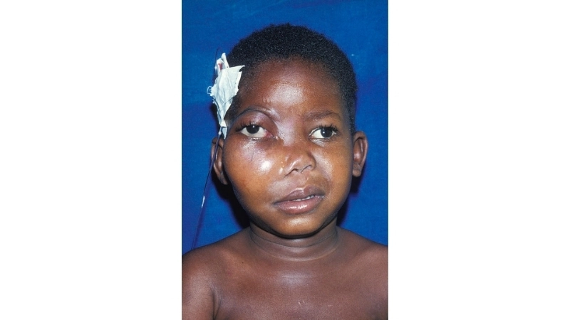 Endemic Burkitt's Lymphoma details