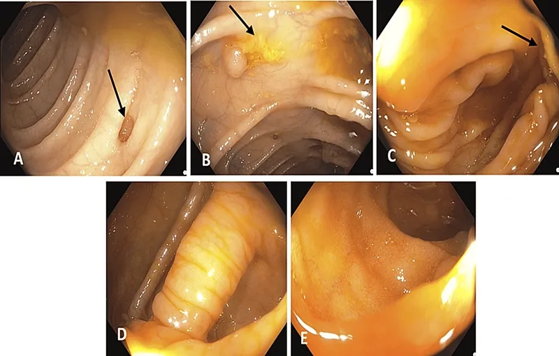 A patient receiving treatment for campylobacteriosis