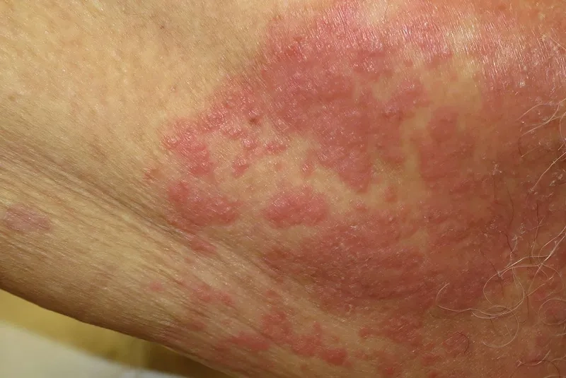 A close-up view of a candidiasis skin rash on an arm