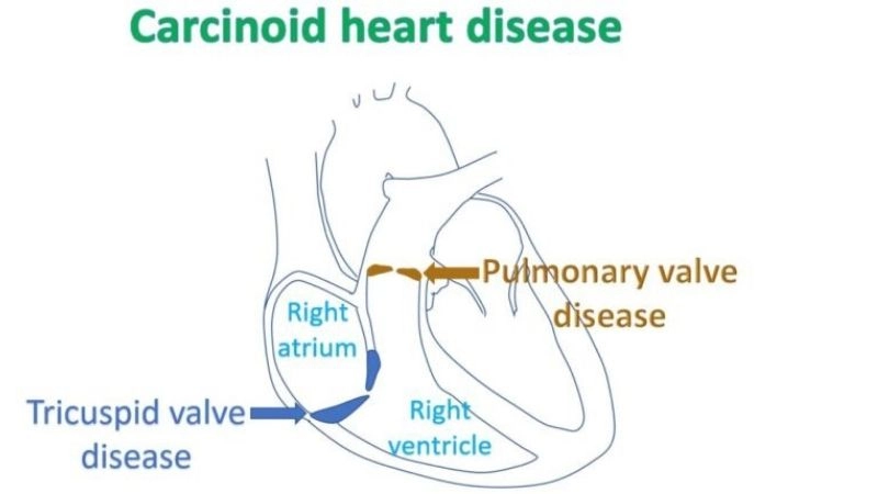 Future outlook in carcinoid heart disease prognosis