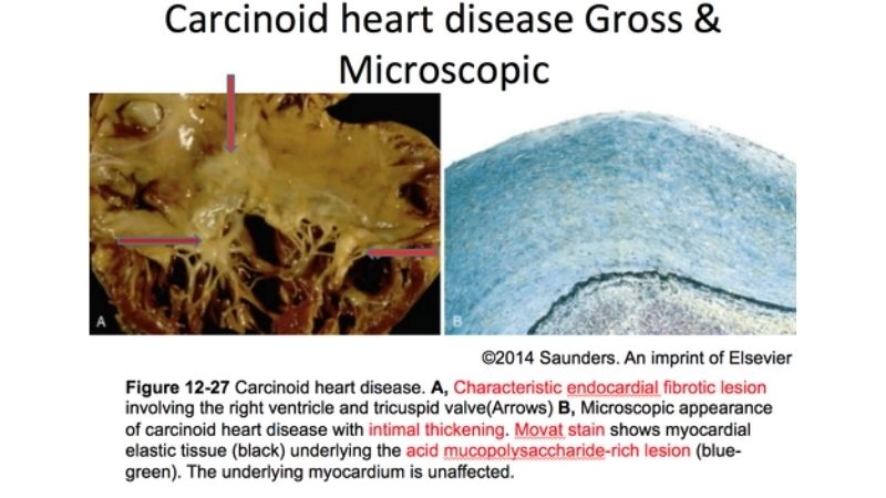 Hidden truth in carcinoid heart disease causes