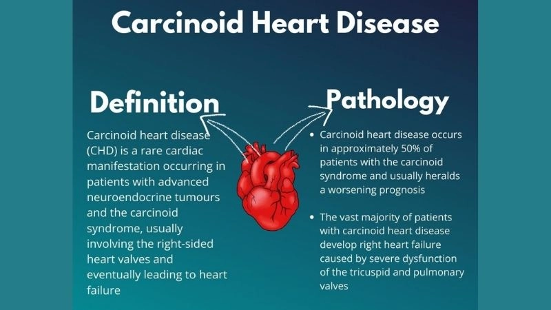 Effective strategies for carcinoid heart disease management