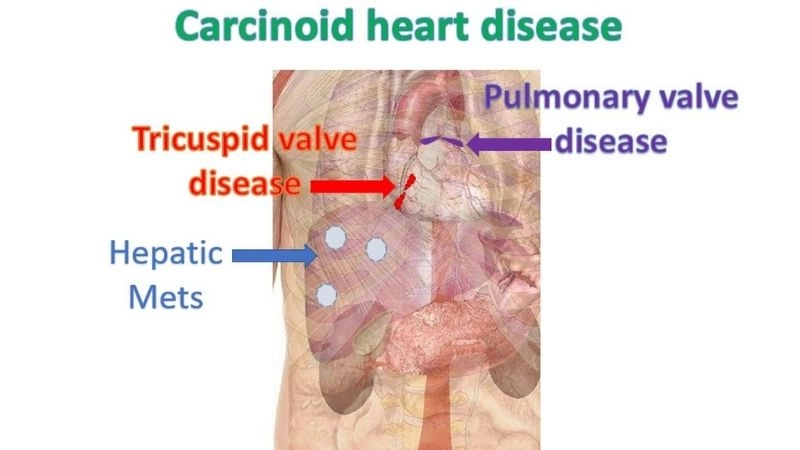 Daily struggles of living with carcinoid heart disease