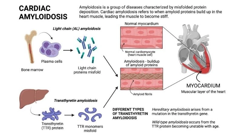 Hidden warning of cardiac amyloidosis symptoms