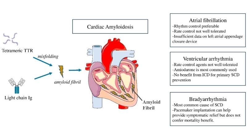 Facts about transthyretin amyloidosis revealed