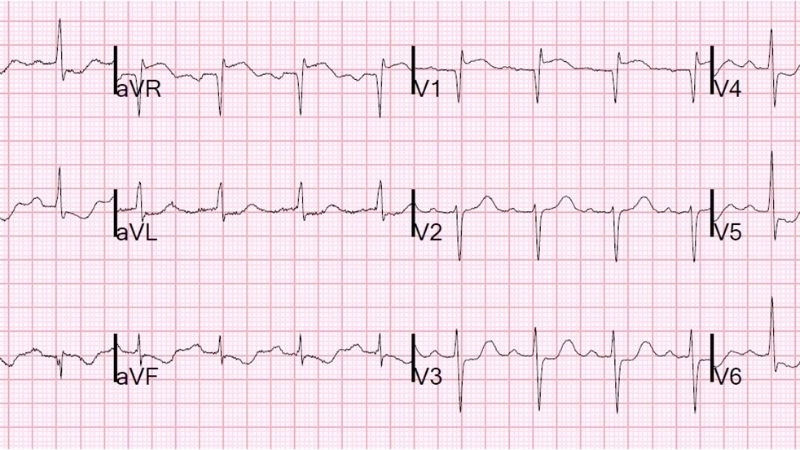 Severe heart trauma from car accident cases