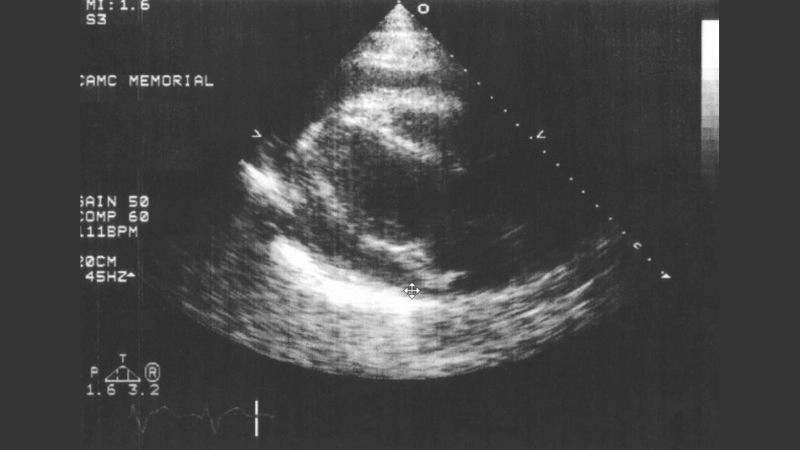 Difference between heart contusion vs heart attack