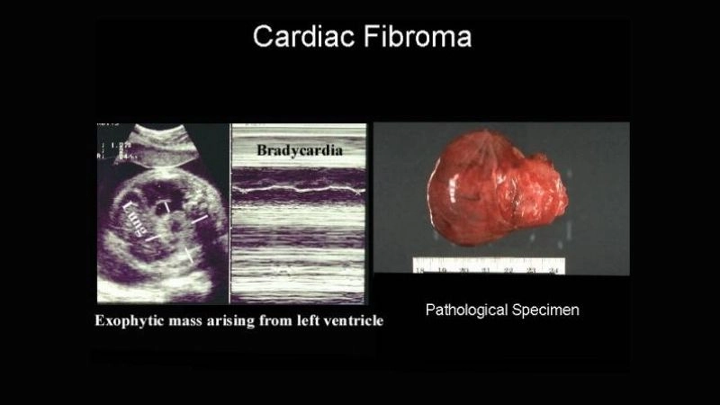 Insightful view of cardiac fibroma treatment