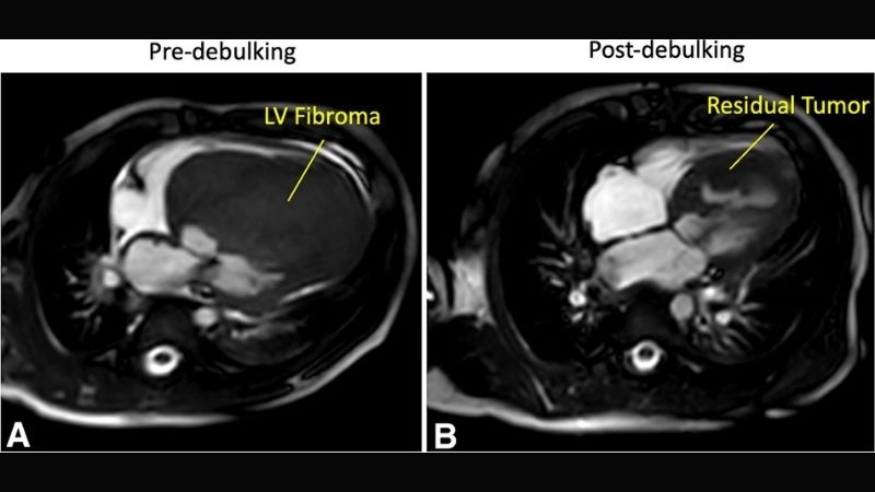 Cardiac fibroma in children touching moments