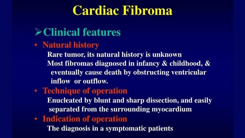 Challenging cardiac fibroma surgery illustrated
