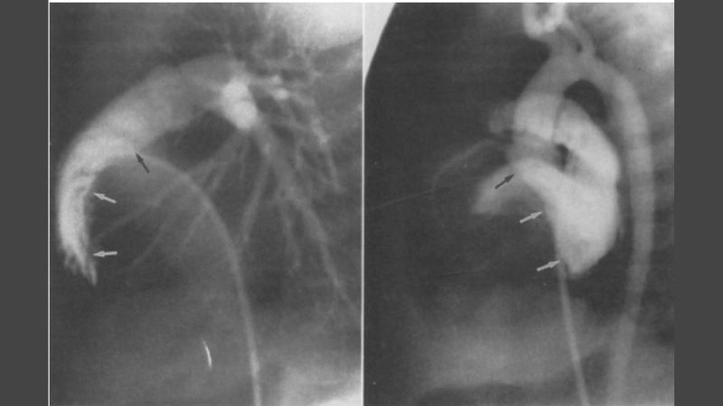 Clear illustration of cardiac fibroma diagnosis