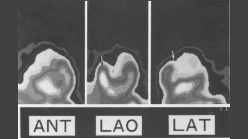 Impressive photo of benign heart tumor findings