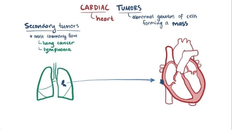 Cardiac myxoma symptoms warning signs of heart tumor