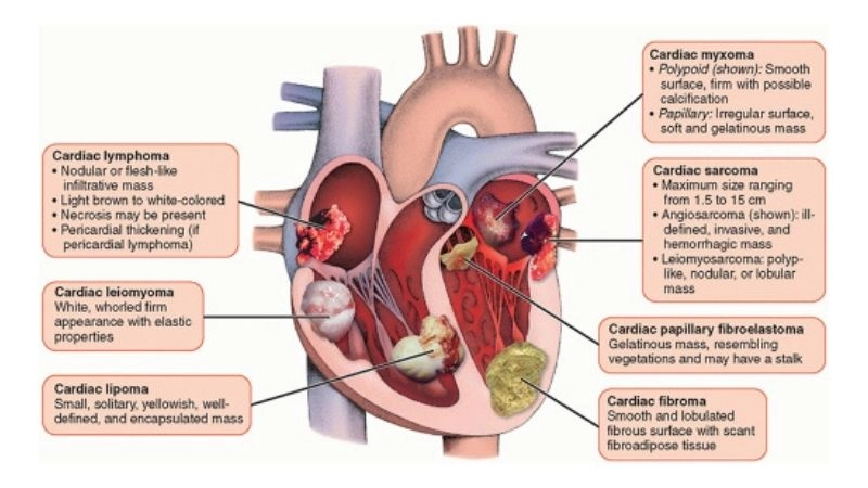 Heart tumor rare growth affecting cardiac function