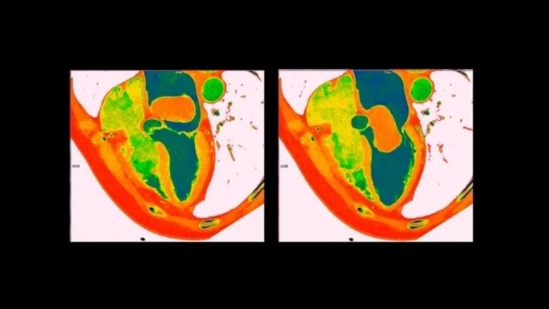 Cardiac myxoma recovery healing process after surgery