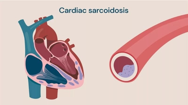 Cardiac sarcoidosis treatment medical and interventional options