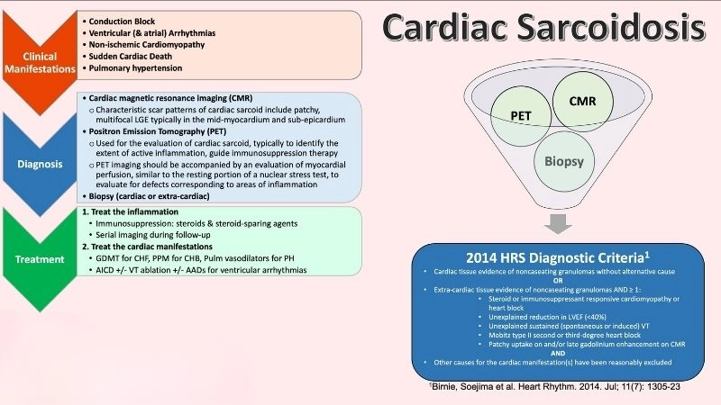 Sarcoidosis of the heart granulomas disrupting normal function