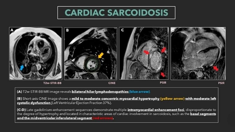 Cardiac sarcoidosis heart failure severe complication of disease