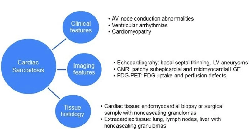 Cardiac sarcoidosis prognosis outcome depends on early treatment