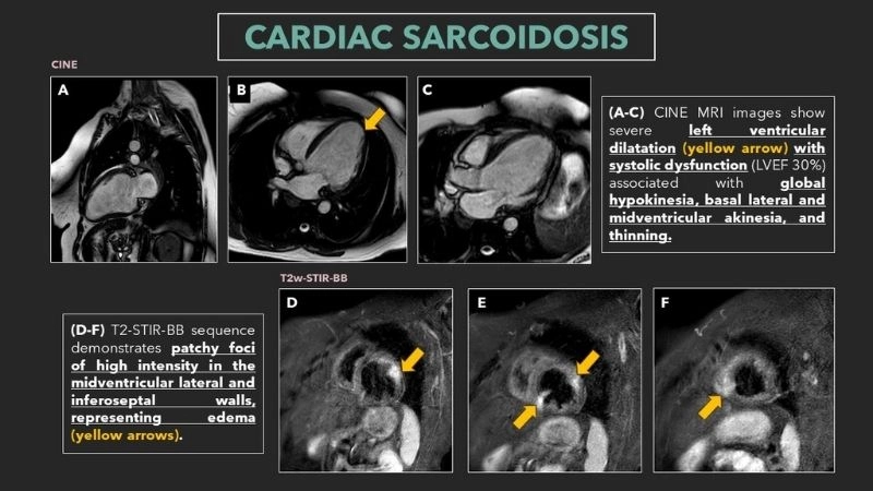 Cardiac sarcoidosis MRI detailed view of heart tissue damage