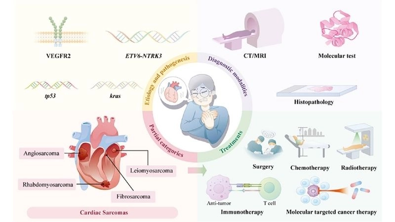 Cardiac angiosarcoma aggressive vascular tumor of the heart