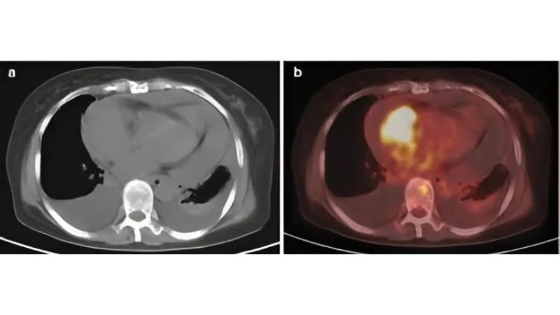 Primary cardiac tumors uncommon growths arising in the heart
