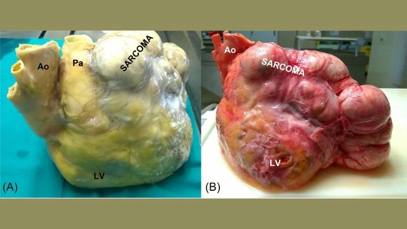 Cardiac sarcoma surgery major operation to remove heart tumor