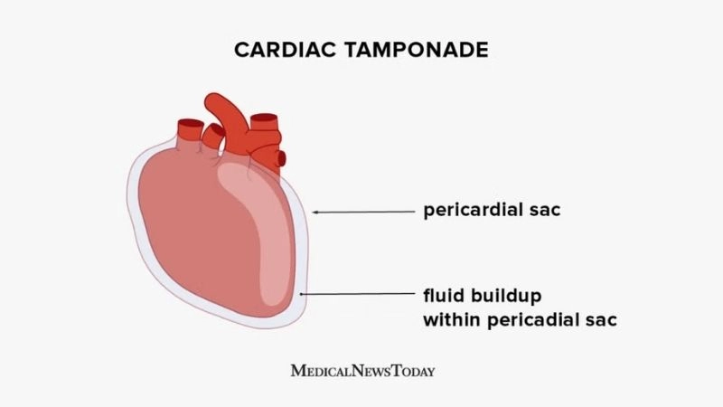 Cardiac tamponade treatment urgent medical and surgical care
