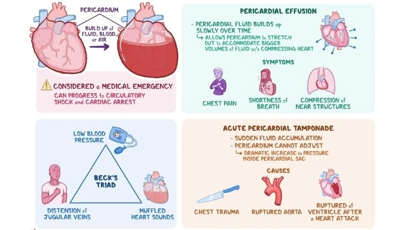 Beck's triad classic clinical signs of cardiac tamponade