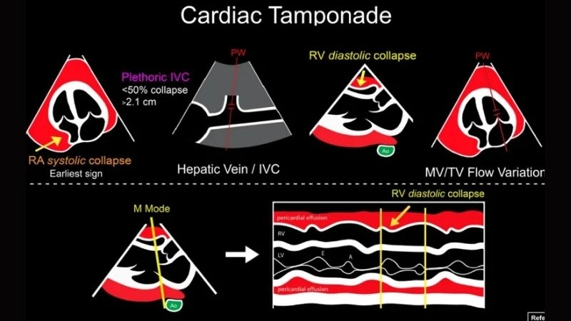 Pericardial effusion fluid buildup that may cause tamponade