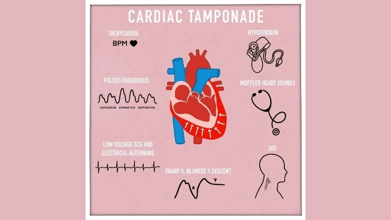 Pulsus paradoxus key blood pressure sign in cardiac tamponade