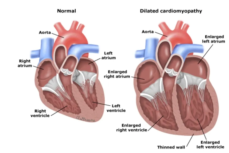Factors affecting cardiomyopathy life expectancy