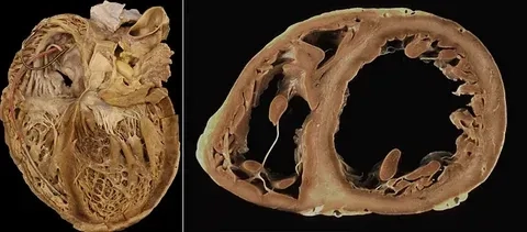 An overview of modern cardiomyopathy treatment options