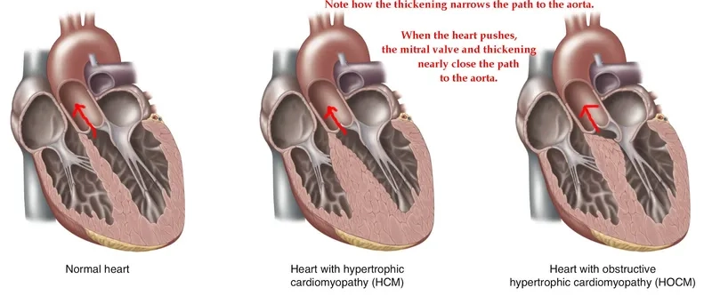 Recognizing the most common cardiomyopathy symptoms