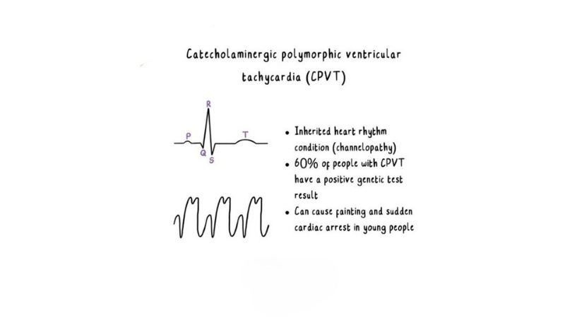 CPVT rare heart rhythm disorder with hidden danger