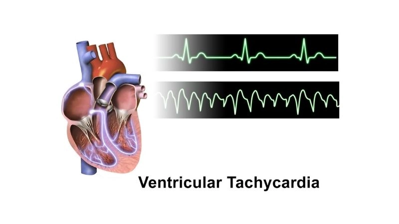Catecholaminergic Polymorphic Ventricular Tachycardia Symptoms show sudden risk