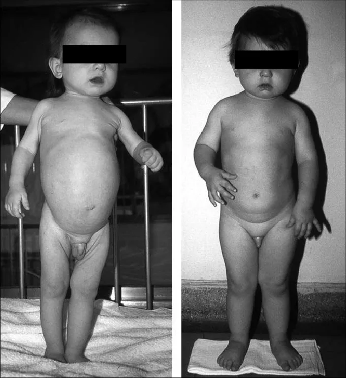 The characteristic celiac rash dermatitis herpetiformis