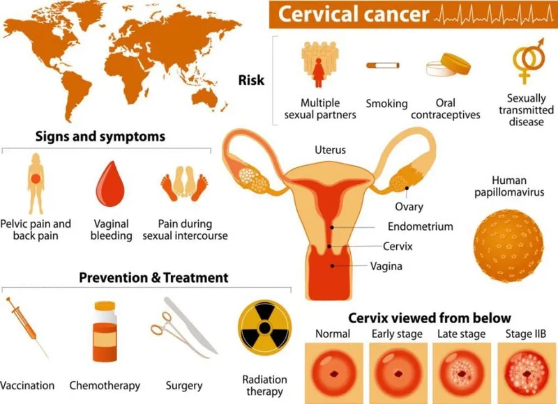 HPV virus illustration linked to cervical cancer