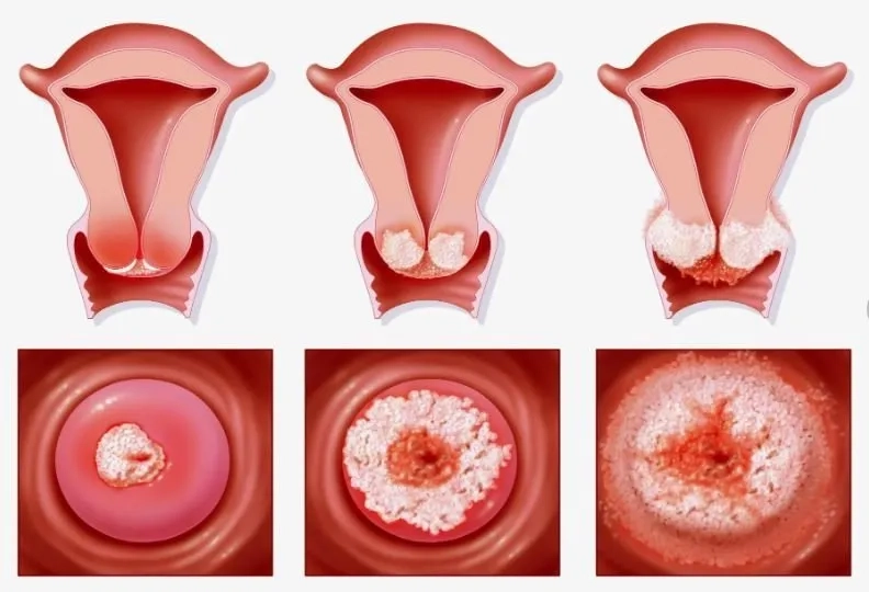 Medical chart of cervical cancer stages