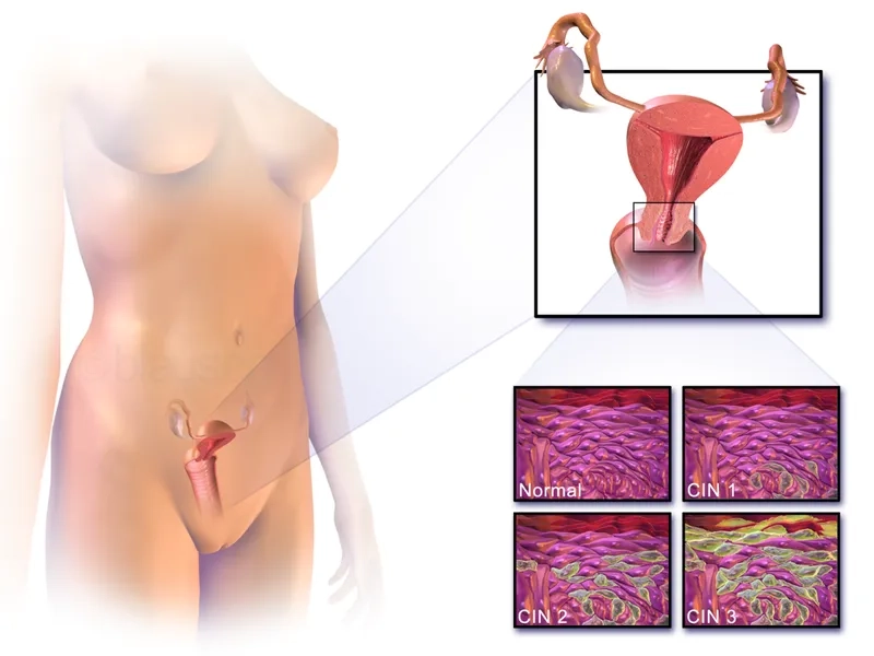 Modern cervical cancer treatment methods
