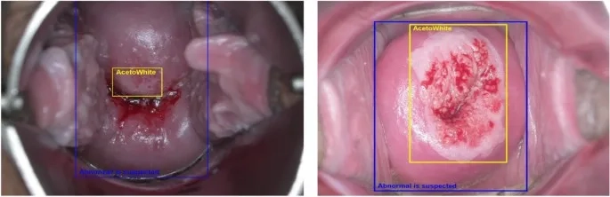 Chart of cervical cancer survival rate