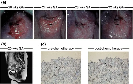Key signs of cervical cancer in women