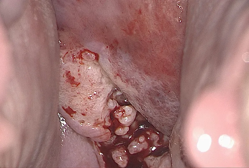 Gardasil cervical cancer vaccine protection