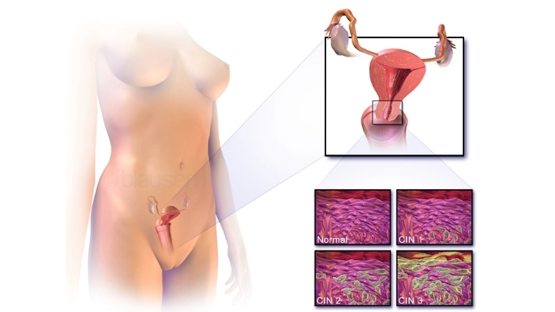 Colon cancer risk shares factors with Cervical Cancer