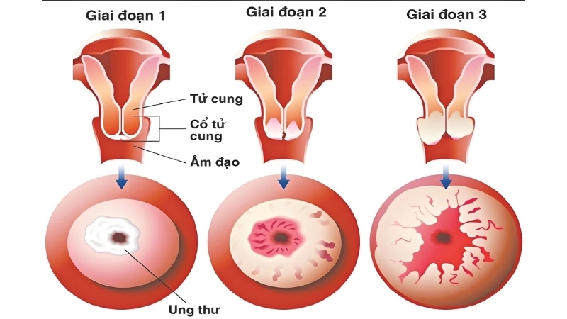 Cervical Cancer treatment improves patient survival