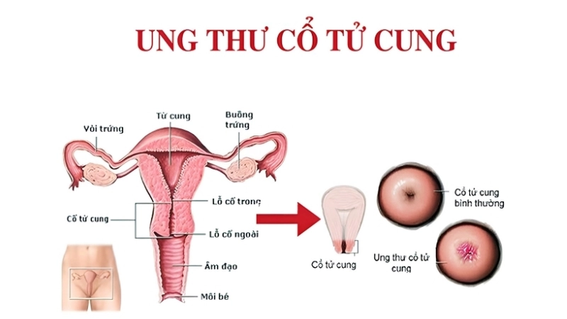 Healthy lifestyle aids Cervical Cancer prevention