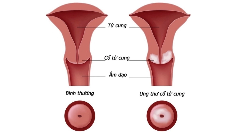 Ovarian cancer awareness links with Cervical Cancer