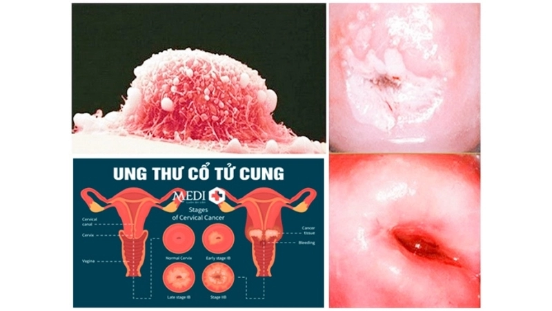 Lung cancer research supports Cervical Cancer fight