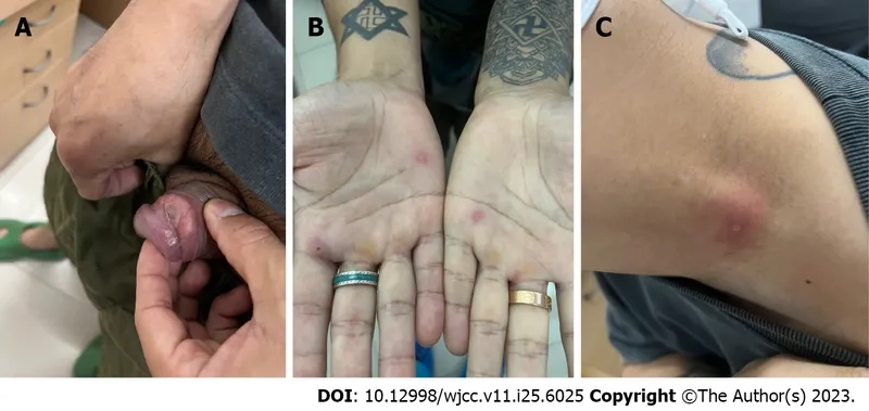 Doctor confirming that chancroid is a curable infection